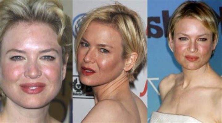 Celebrities with Rosacea Famous People With Rosacea