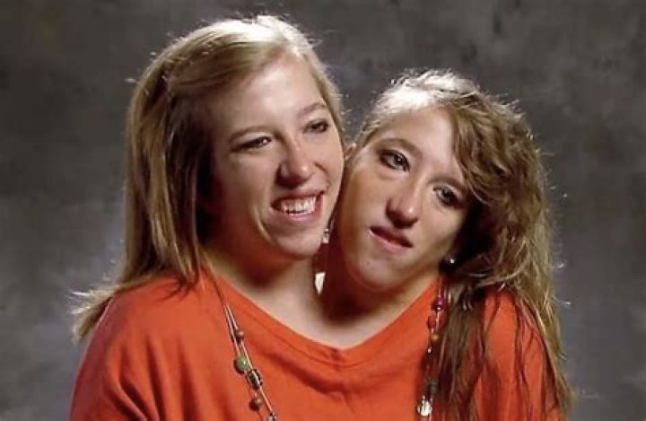 Conjoined Twins Abby and Brittany Hensel Seem to Respond to Marriage